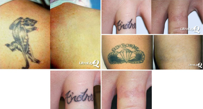 Laser Tattoo Removal